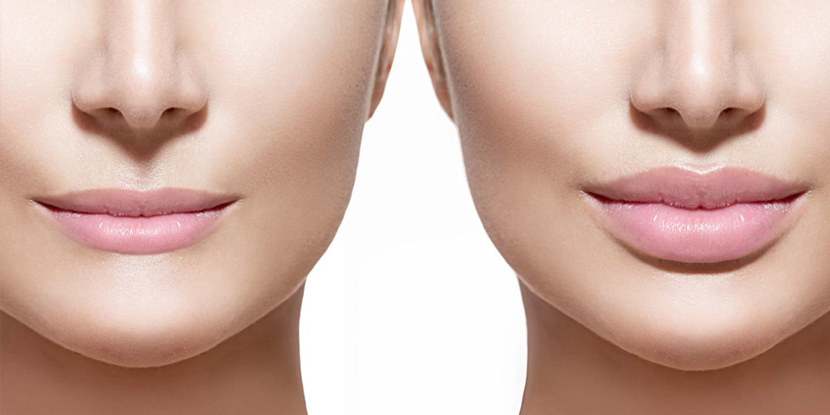 img-trat-preenchimento-labial-02