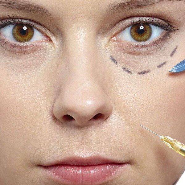 img-trat-preenchimento-olheiras-01