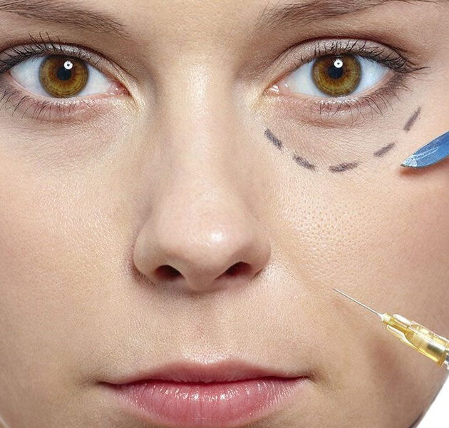 img-trat-preenchimento-olheiras-01